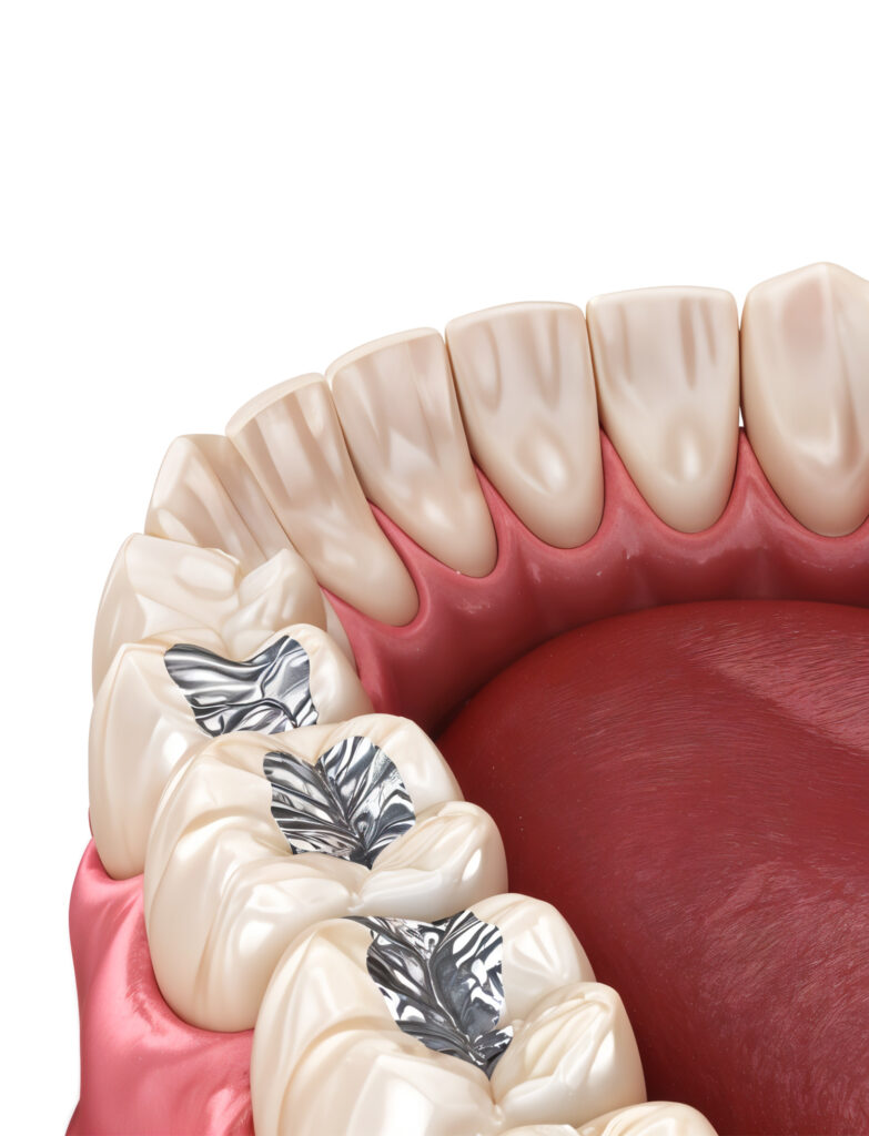 Remoção de Amálgama 