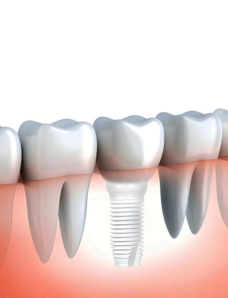 Implantes de Zircônia 